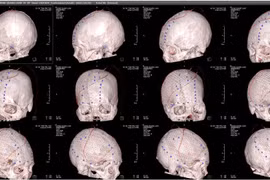 Phẫu thuật tạo hình bằng lưới titan 3D ghép sọ cho nhân viên y tế khuyết sọ