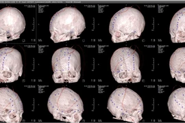 Phẫu thuật tạo hình bằng lưới titan 3D ghép sọ cho nhân viên y tế khuyết sọ