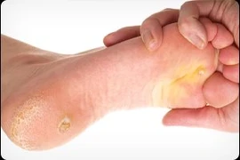 Xử lý vết chai chân