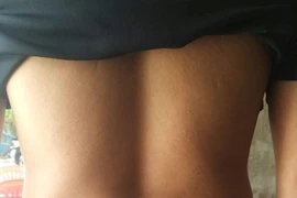 Muốn bệnh khỏi nhanh, vội vàng cấy chỉ