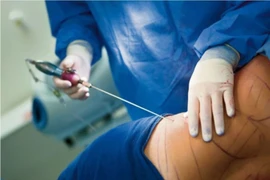 Tử vong vì sốc nhiễm trùng sau hút mỡ bụng