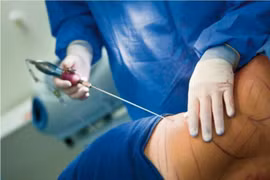 Tử vong vì sốc nhiễm trùng sau hút mỡ bụng