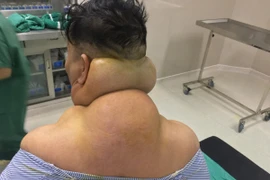 Nghiện rượu mọc u khổng lồ