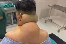 Nghiện rượu mọc u khổng lồ