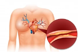 Máu nhiễm mỡ – yếu tố nguy cơ cao gây xơ vữa động mạch