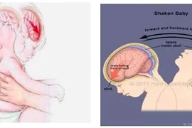 Trẻ xuất huyết não vì sự rung lắc dỗ dành