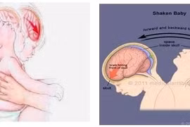 Trẻ xuất huyết não vì sự rung lắc dỗ dành