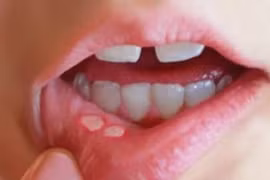 Loét miệng khó nuốt lo ung thư