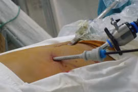 Nhiễm trùng lỗ trocar