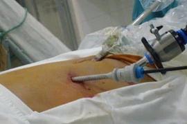 Nhiễm trùng lỗ trocar