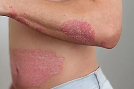 Giải pháp cải thiện bệnh vảy nến an toàn, hiệu quả từ sản phẩm thảo dược