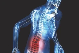 Đau lưng do u cột sống nguyên phát và di căn 