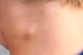 Tưởng mắc ung thư hóa ra lao hạch 