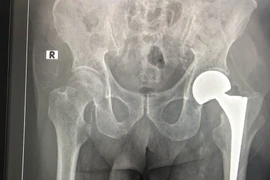 Thay khớp háng cho bệnh nhân 98 tuổi