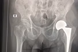 Thay khớp háng cho bệnh nhân 98 tuổi