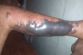 Chân hoại tử và suýt tử vong sau 1 ngày vi khuẩn lạ tấn công từ vết xước nhỏ...
