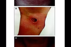 Đốt sóng cao tần điều trị nhân tuyến giáp có thể mất não