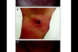 Đốt sóng cao tần điều trị nhân tuyến giáp có thể mất não