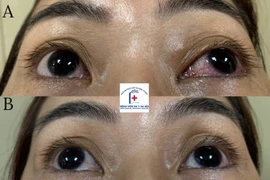 Nút mạch điều trị thông động mạch cảnh xoang hang hiếm gặp