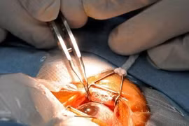 Sau phẫu thuật phải ngừng thể thao?