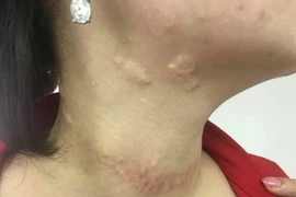 Sẹo chằng chịt vì chữa bướu cổ bằng đắp lá