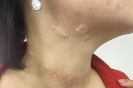 Sẹo chằng chịt vì chữa bướu cổ bằng đắp lá