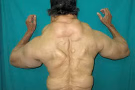 Thích uống rượu sinh bệnh u mỡ 