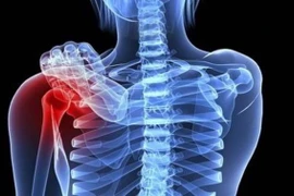 U xương bả vai có phải ung thư?