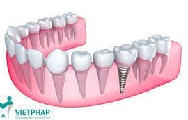 Cấy răng giả vào chỗ răng hỏng