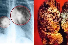 Ung thư phổi di căn