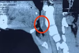 Uống vitamin C cho xương cá tan, bệnh nhân bị nhiễm trùng vùng cổ nặng