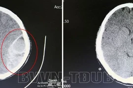 Hôn mê do chủ quan chấn thương vùng đầu không đi khám