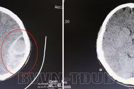 Hôn mê do chủ quan chấn thương vùng đầu không đi khám