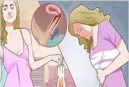 Lệch vòng tránh thai vì chơi thể thao