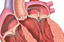  Thay van tim có nguy hiểm không? 