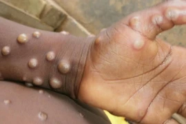 Lo ngại đại dịch virus đậu mùa khỉ bùng phát sau COVID-19