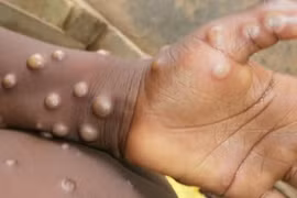 Lo ngại đại dịch virus đậu mùa khỉ bùng phát sau COVID-19