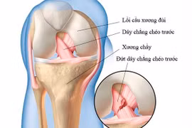Điều trị đứt dây chằng chéo