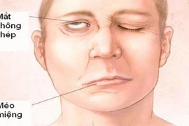 Liệt mặt vì thích ngủ nơi gió lùa