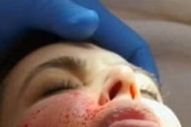 Nhiễm khuẩn da vì làm đẹp bằng máu tự thân