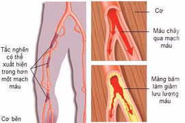 Can thiệp động mạch chậu – chi dưới qua da bằng ống thông
