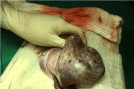 13 tuổi đã bị u nang buồng trứng to như quả bóng