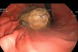 Đọng u bã thức ăn vì chăm ăn nghệ