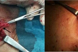 Ruột thừa viêm hoại tử chui vào khối thoát vị đùi