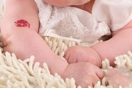 Bớt đỏ phải khám cẩn thận trước điều trị