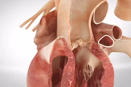 Tăng huyết áp gây lóc tách động mạch chủ