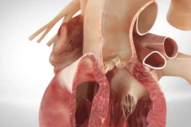 Tăng huyết áp gây lóc tách động mạch chủ