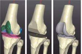 Sử dụng công nghệ in 3D để đổi mới vật liệu hợp kim y tế