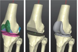 Sử dụng công nghệ in 3D để đổi mới vật liệu hợp kim y tế