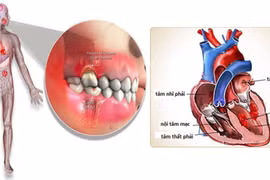 Viêm nội tâm mạc nhiễm khuẩn